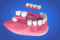 Removable partial denture. Medically accurate Royalty Free Stock Photo