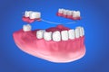 Removable partial denture. Medically accurate Royalty Free Stock Photo