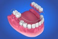 Removable partial denture. Medically accurate