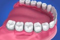 Removable partial denture. Medically accurate