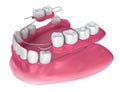 Removable partial denture. Medically accurate