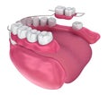 Removable partial denture. Medically accurate Royalty Free Stock Photo