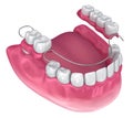 Removable partial denture. Medically accurate