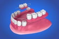 Removable partial denture.