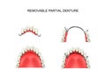 Removable partial denture