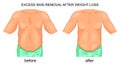 Removal of excess skin after weight loss Royalty Free Stock Photo