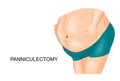 Removal of fat apron. panniculectomy