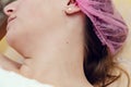 Removal of papillomas on neck in a beauty salon