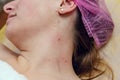 Removal of papillomas on neck in a beauty salon