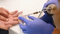 Removal of papillomas and warts on the hand with liquid nitrogen in a special device with a probe - cryodestructors.