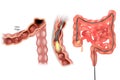 Removal polyps of the Colon. Colonoscopy