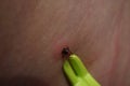 Removal of sucking tick, Ixodes ricinus, from human skin with yellow tweezers Royalty Free Stock Photo