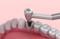 Removing the caries . Medically accurate tooth illustration