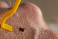 Removing a tick from a human body with a hook. Ixod persulcatus. Man unscrews Royalty Free Stock Photo