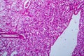 Renal cell carcinoma, light micrograph Royalty Free Stock Photo