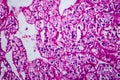 Renal cell carcinoma, light micrograph Royalty Free Stock Photo