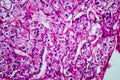 Renal cell carcinoma, light micrograph Royalty Free Stock Photo