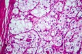 Renal cell carcinoma, light micrograph Royalty Free Stock Photo