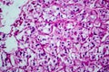 Renal cell carcinoma, light micrograph Royalty Free Stock Photo