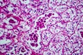 Renal cell carcinoma, light micrograph Royalty Free Stock Photo