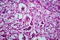 Renal cell carcinoma, light micrograph Royalty Free Stock Photo