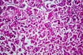 Renal cell carcinoma, light micrograph Royalty Free Stock Photo