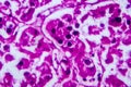 Renal cell carcinoma, light micrograph