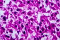 Renal cell carcinoma, light micrograph Royalty Free Stock Photo
