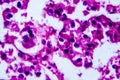 Renal cell carcinoma, light micrograph Royalty Free Stock Photo