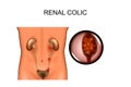 Renal colic. locations