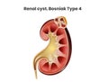 Renal cyst, Bosniak type 4. A complex cyst of the kidney. Renal cell carcinoma Royalty Free Stock Photo