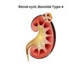 Renal cyst, Bosniak type 4. A complex cyst of the kidney. Renal cell carcinoma