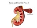 Renal cyst, Bosniak type 2. A simple cyst of the kidney with the septation Royalty Free Stock Photo