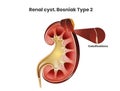 Renal cyst, Bosniak type 2. A simple cyst of the kidney with the septation