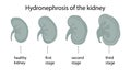 Renal hydronephrosis is a progressive,stages of the disease