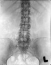 Renal pelvis spine xray (x-ray)