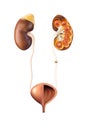 renal system and kidney stones