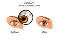 Replacement of the crystalline lens in cataract Royalty Free Stock Photo