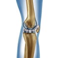 Replacement Knee