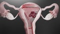 Reproductive system, cancer cells, ovaries cysts, cervical cancer, growing cells, gynecological
