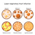 Respiratory infection. Close-up of viruses and bacteria