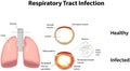 Respiratory Tract Infection