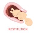 Restitution stage of baby birth in vaginal delivery