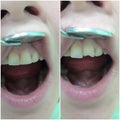 restoration of front teeth