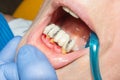 Restoration of a rotten tooth decayed tooth close-up. The concept of therapeutic aesthetic dentistry in the dental clinic