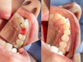 Restoration and sealing of a tooth with a fiberglass beam pin. Close-up photopolymer material using system Rabberdam in