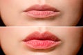 Result before and after lip shaping. A woman makes lip shape correction in a cosmetology clinic. Lip injections, lip Royalty Free Stock Photo