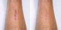 Result after procedure of scar removing.Laser removal.Before and after treatment
