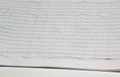 Results of an electroencephalogram after a neurophysiological examination, which is the recording of brain bioelectric activity at Royalty Free Stock Photo