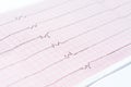 ECG with single ventricular complexes and and ventricular asystole